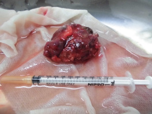 摘出された腫瘤