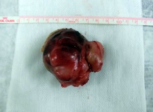ゴールデンハムスターの体表腫瘍 摘出された腫瘍