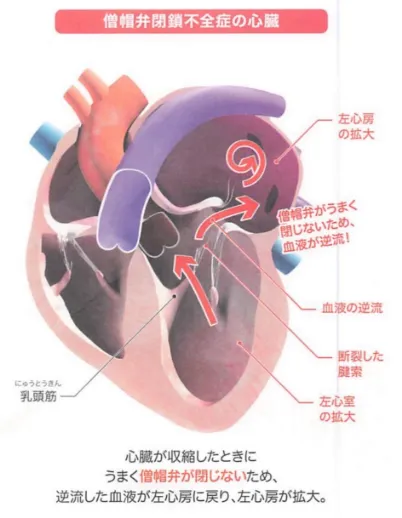 僧帽弁閉鎖不全症な心臓